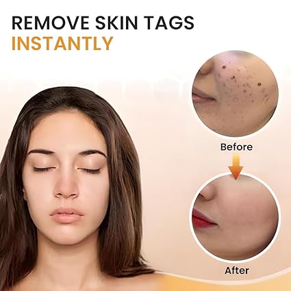 🌸 Skin Tag Remover -TagFree™ Visible Results, Beautiful Skin | FLAT 45% OFF 🔥