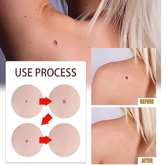 🌸 Skin Tag  Remover -TagFree™ Visible Results, Beautiful Skin | FLAT 45% OFF 🔥